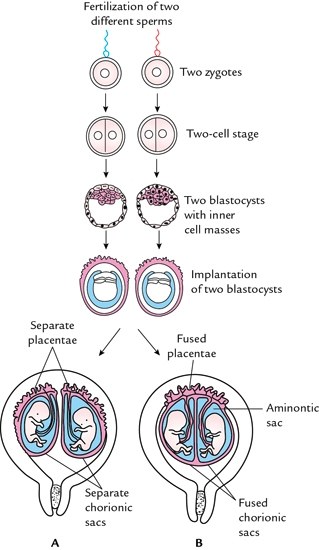 dizygotic twins, fetal membranes